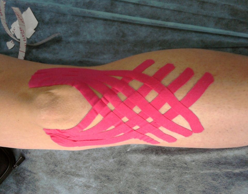 Torcedura de una articulación